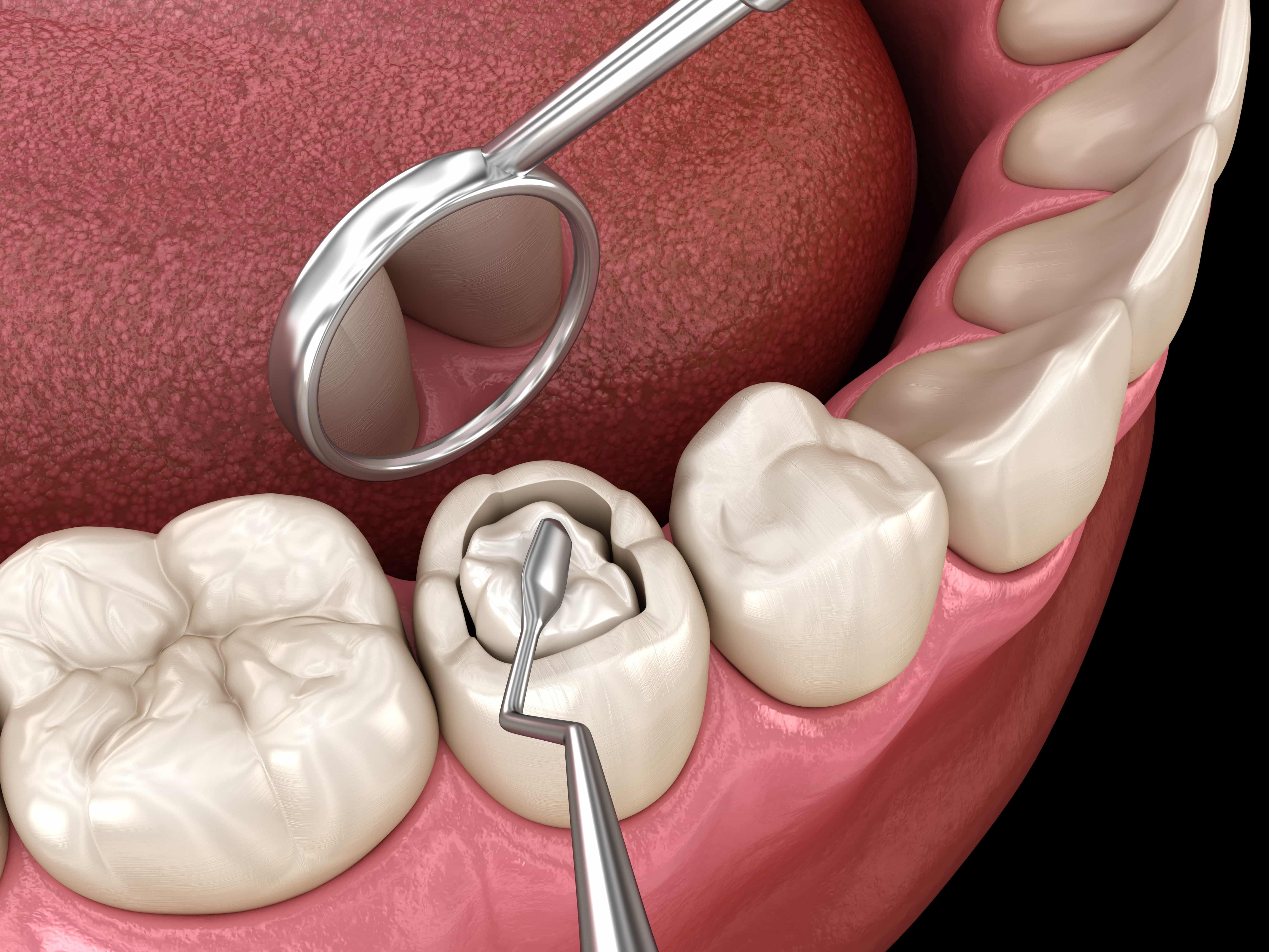 THE BEAUTY OF COMPOSITE FILLINGS