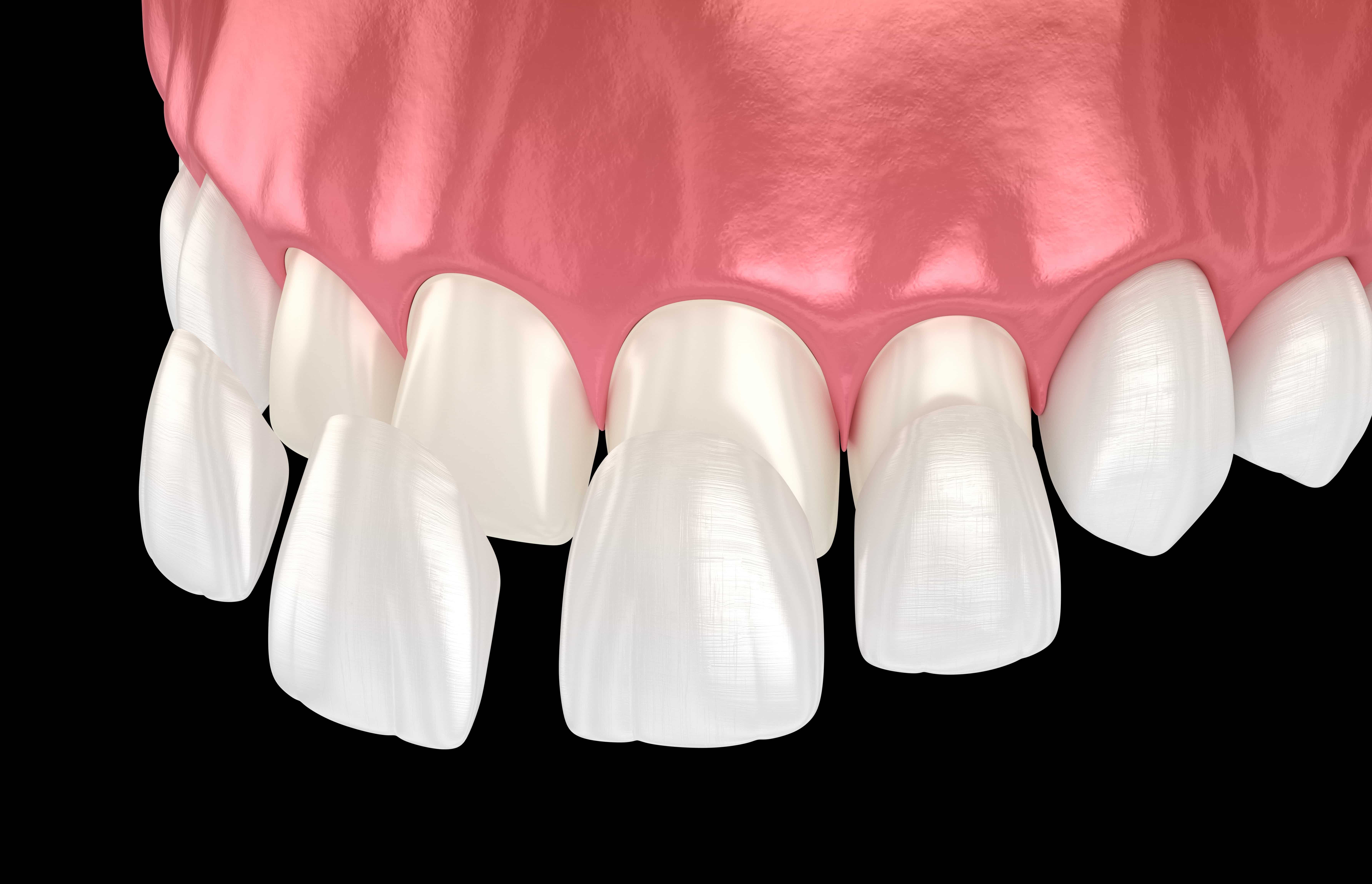 THE MAGIC OF VENEERS