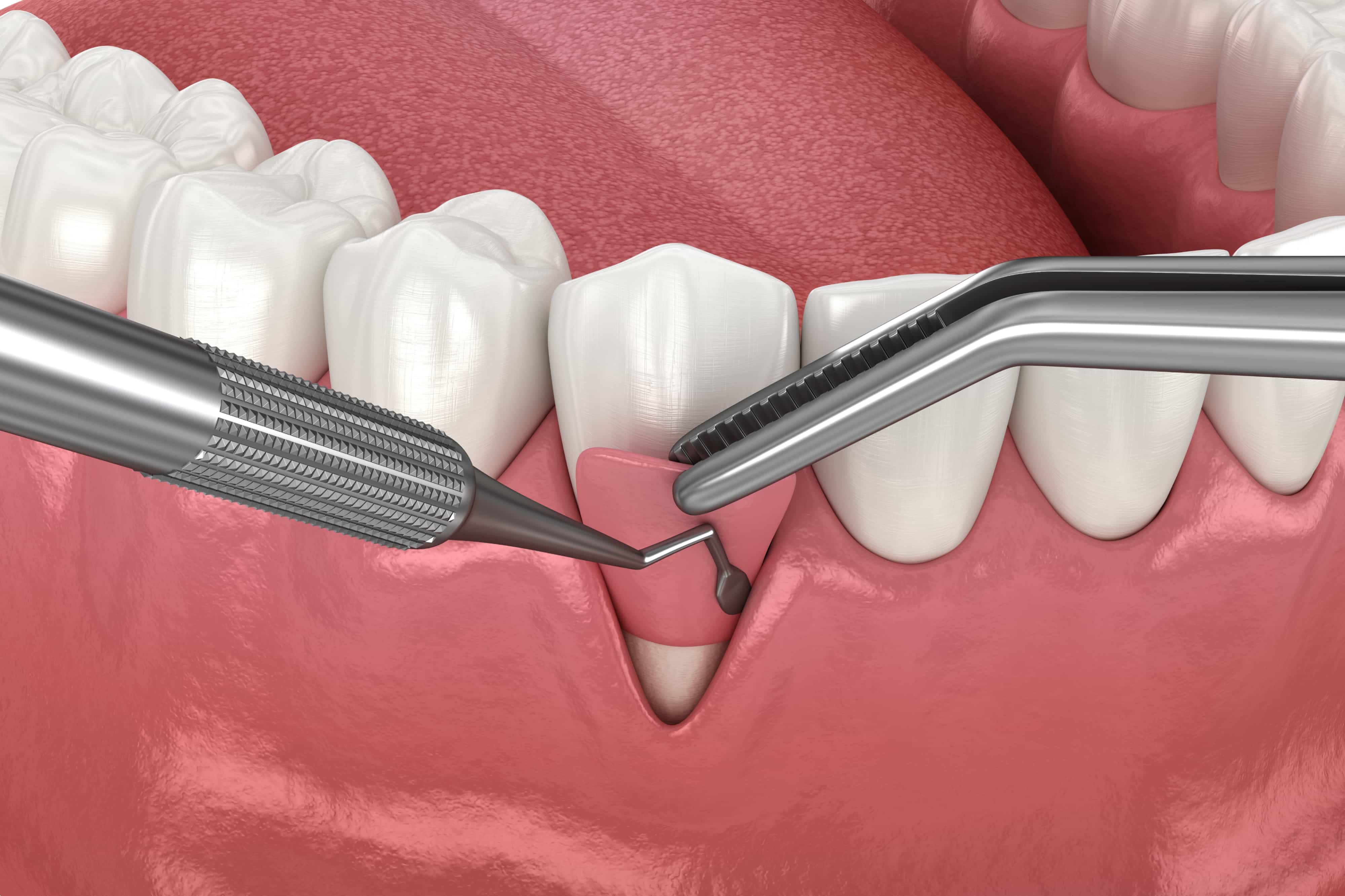 THE BENEFITS OF SOFT TISSUE GRAFTING